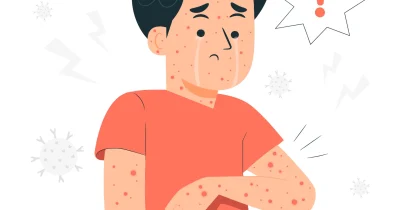 Seboroični dermatitis blog post
