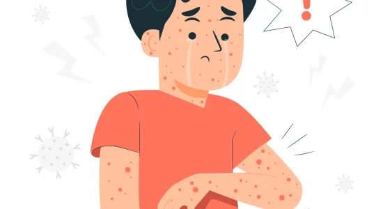 Seboroični dermatitis blog post